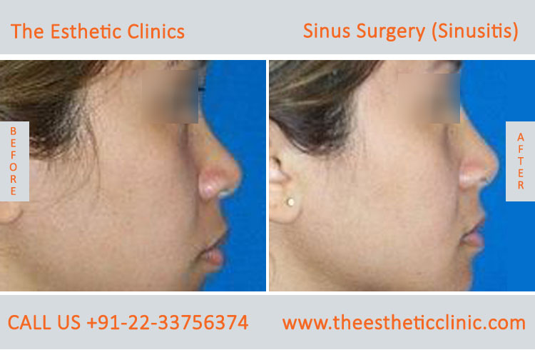 Sinus Surgery, Sinusitis before after photos in mumbai india (3)